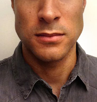 Jaw Implants Before & After Gallery - Patient 152269 - Image 2
