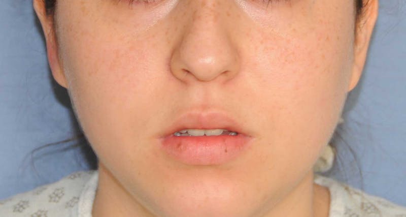 Lip Augmentation Before & After Gallery - Patient 694614 - Image 1