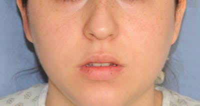 Lip Augmentation Before & After Gallery - Patient 694614 - Image 1