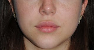 Lip Augmentation Before & After Gallery - Patient 694614 - Image 2