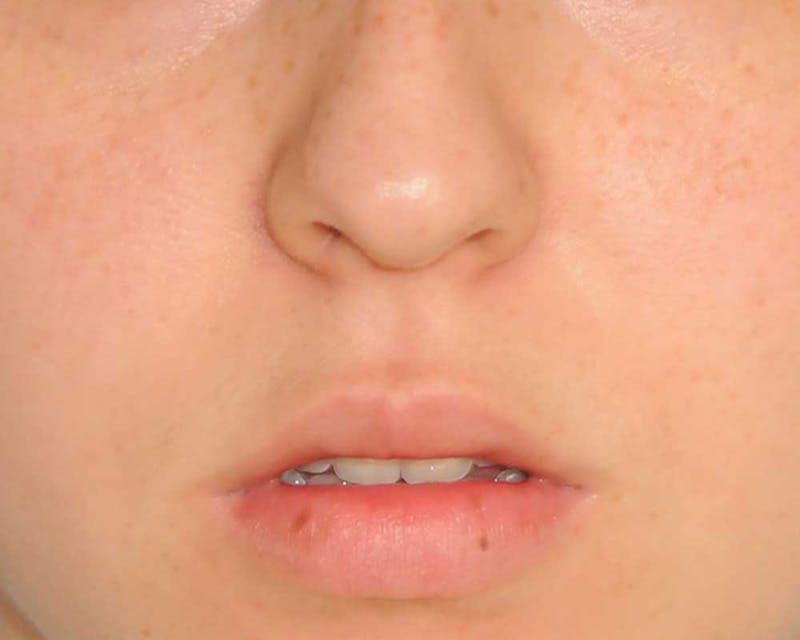 Lip Augmentation Before & After Gallery - Patient 694614 - Image 3