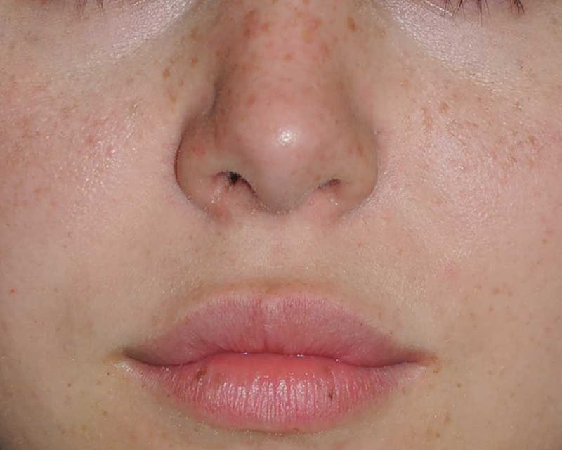 Lip Augmentation Before & After Gallery - Patient 694614 - Image 4