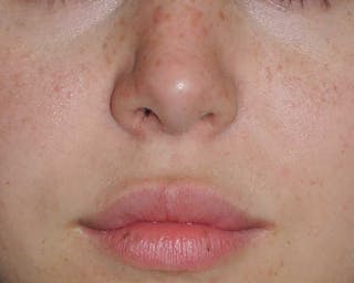 Lip Augmentation Before & After Gallery - Patient 694614 - Image 4