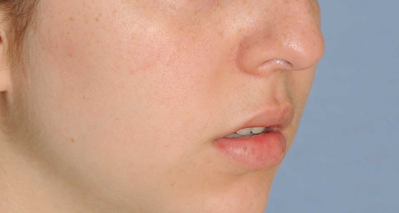 Lip Augmentation Before & After Gallery - Patient 694614 - Image 5