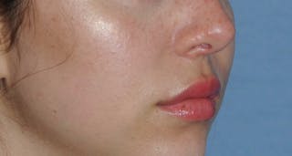 Lip Augmentation Before & After Gallery - Patient 694614 - Image 6