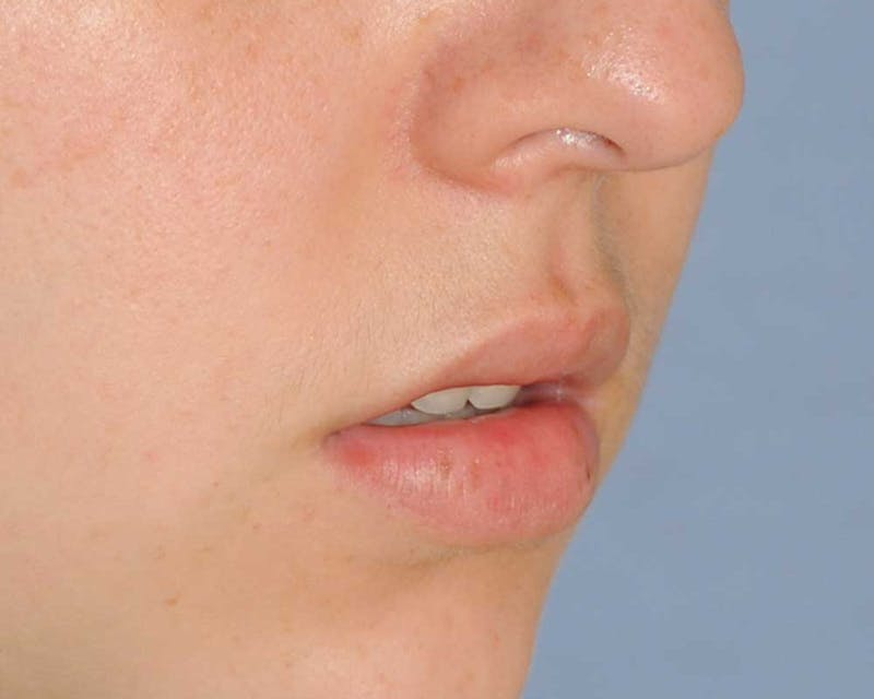 Lip Augmentation Before & After Gallery - Patient 694614 - Image 7
