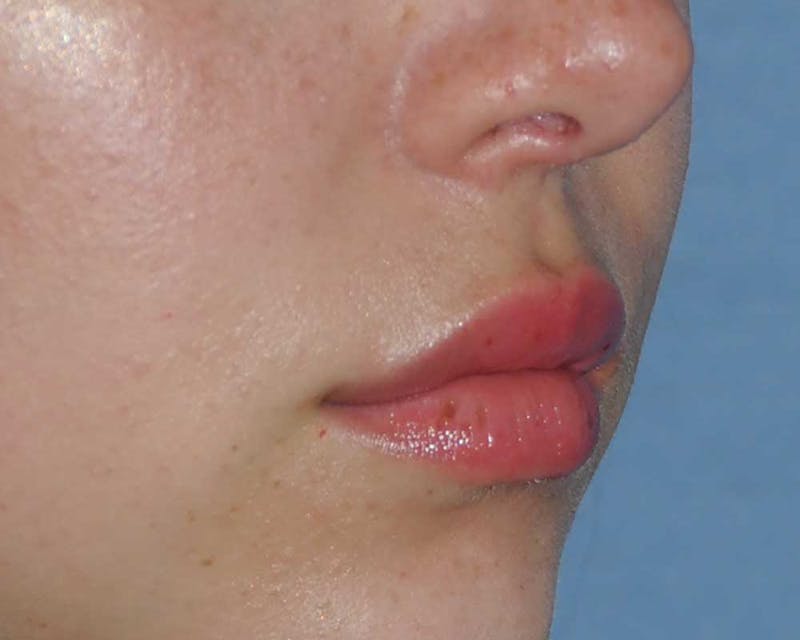 Lip Augmentation Before & After Gallery - Patient 694614 - Image 8