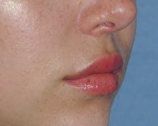Lip Augmentation Before & After Gallery - Patient 694614 - Image 8