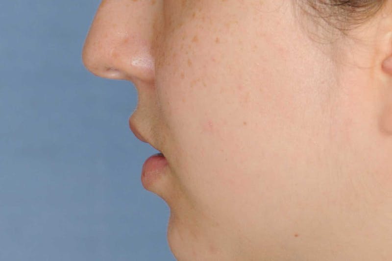 Lip Augmentation Before & After Gallery - Patient 694614 - Image 9