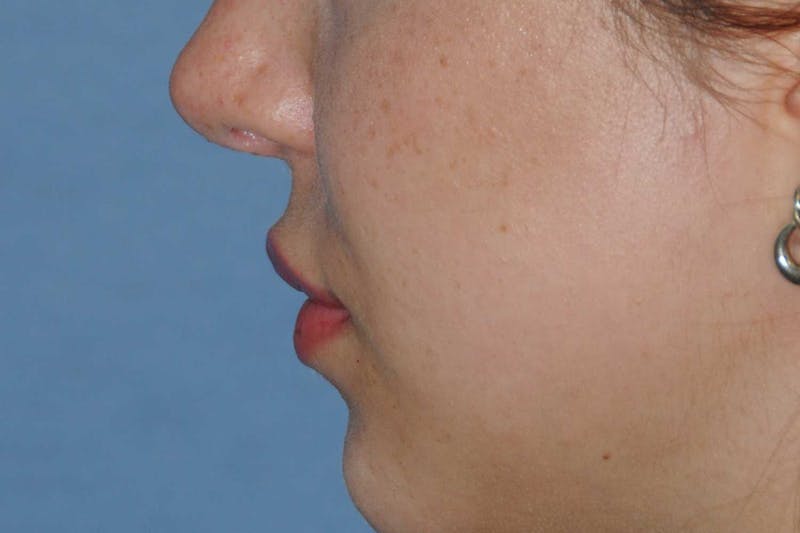 Lip Augmentation Before & After Gallery - Patient 694614 - Image 10