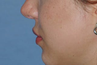 Lip Augmentation Before & After Gallery - Patient 694614 - Image 10