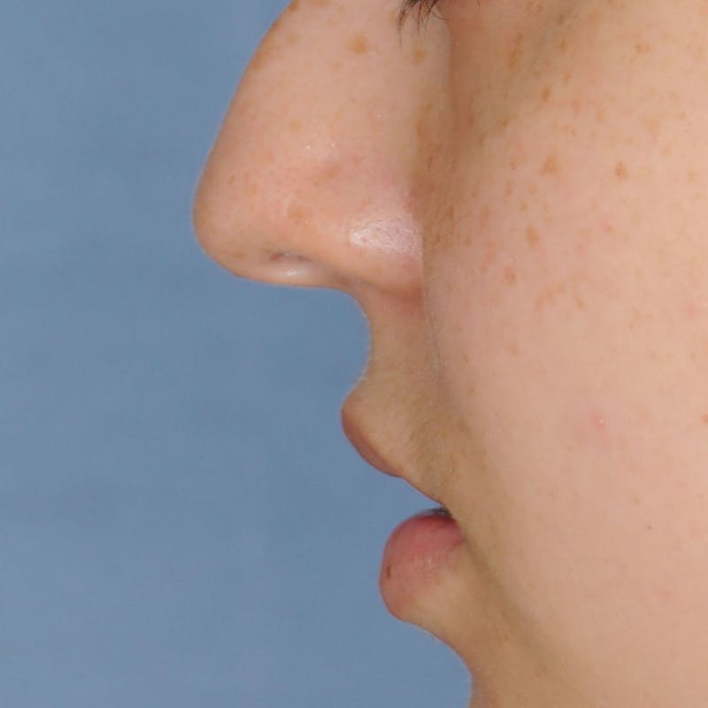 Lip Augmentation Before & After Gallery - Patient 694614 - Image 11