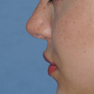 Lip Augmentation Before & After Gallery - Patient 694614 - Image 12