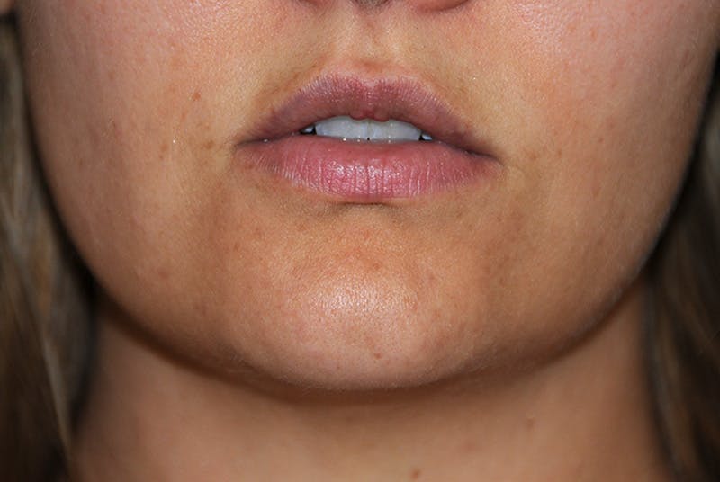 Lip Augmentation Before & After Gallery - Patient 243931 - Image 1