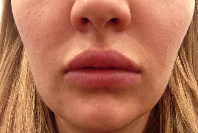 Lip Augmentation Before & After Gallery - Patient 243931 - Image 2