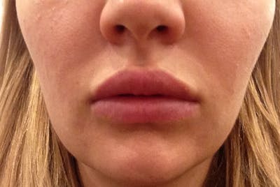 Lip Augmentation Before & After Gallery - Patient 243931 - Image 2
