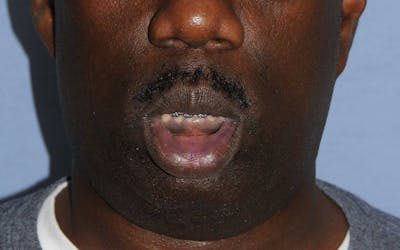Lip Augmentation Before & After Gallery - Patient 218121 - Image 1