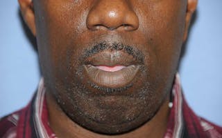 Lip Augmentation Before & After Gallery - Patient 218121 - Image 2