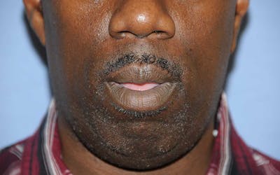 Lip Augmentation Before & After Gallery - Patient 218121 - Image 2