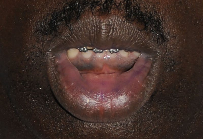Lip Augmentation Before & After Gallery - Patient 218121 - Image 3