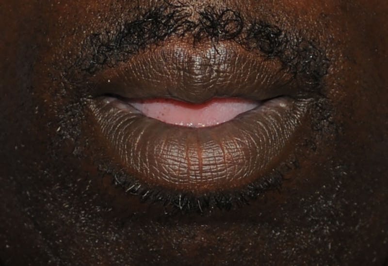Lip Augmentation Before & After Gallery - Patient 218121 - Image 4