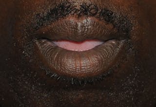 Lip Augmentation Before & After Gallery - Patient 218121 - Image 4