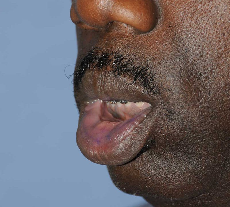Lip Augmentation Before & After Gallery - Patient 218121 - Image 5