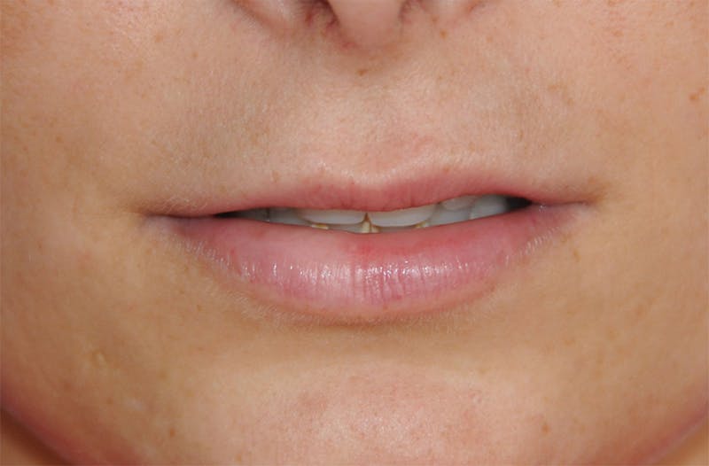 Lip Augmentation Before & After Gallery - Patient 117606 - Image 1