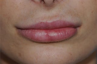 Lip Augmentation Before & After Gallery - Patient 117606 - Image 2
