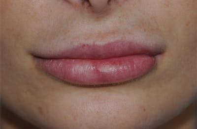 Lip Augmentation Before & After Gallery - Patient 117606 - Image 2