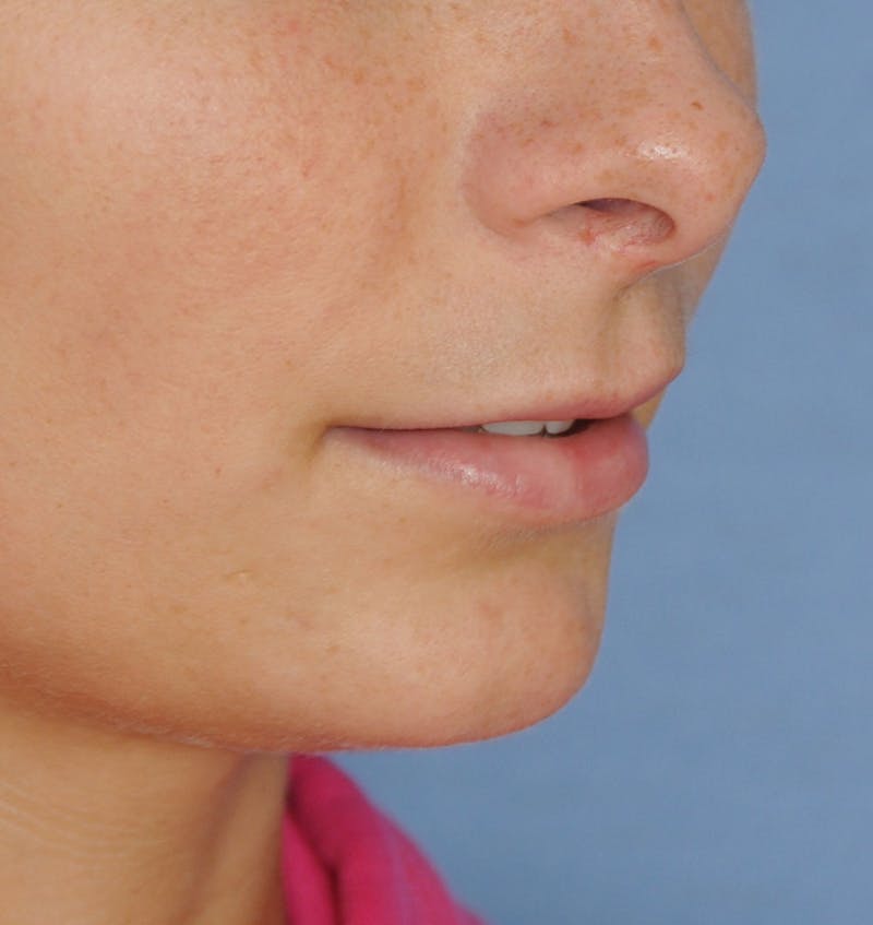 Lip Augmentation Before & After Gallery - Patient 117606 - Image 3
