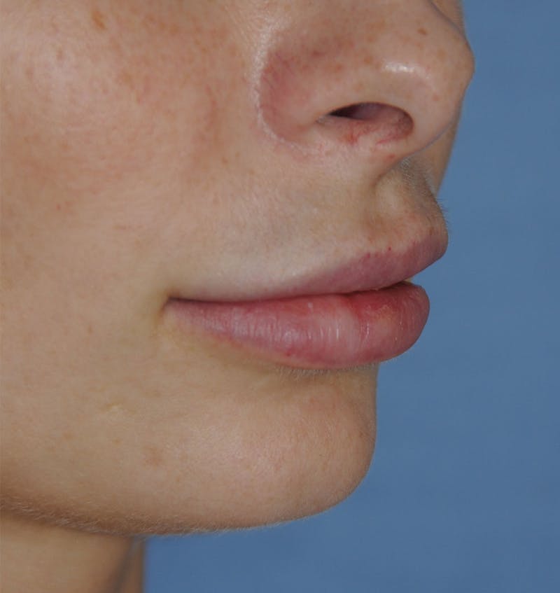 Lip Augmentation Before & After Gallery - Patient 117606 - Image 4