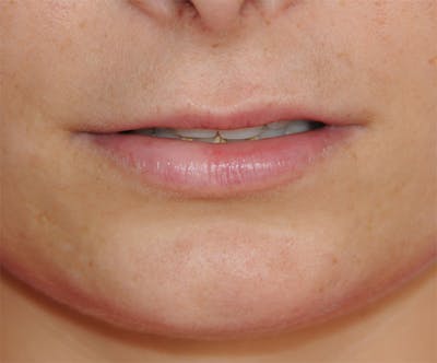 Facial Fillers / Injectables Before & After Gallery - Patient 409586 - Image 1