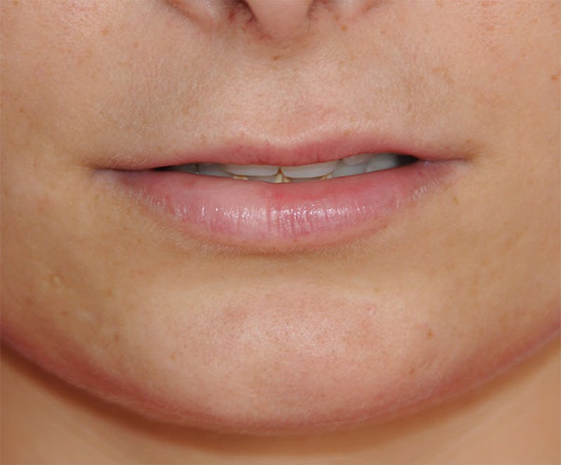Lip Augmentation Before & After Gallery - Patient 117606 - Image 5