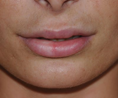 Facial Fillers / Injectables Before & After Gallery - Patient 409586 - Image 2