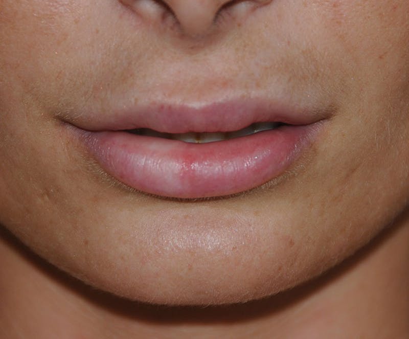 Lip Augmentation Before & After Gallery - Patient 117606 - Image 6