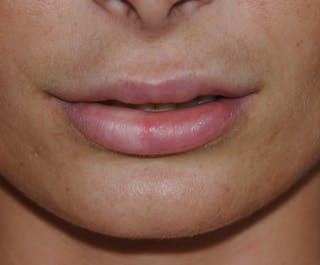 Lip Augmentation Before & After Gallery - Patient 117606 - Image 6