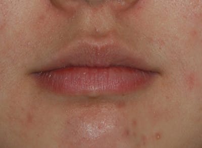 Lip Augmentation Before & After Gallery - Patient 250107 - Image 1