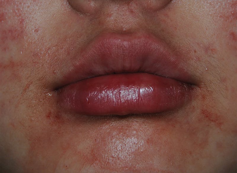 Lip Augmentation Before & After Gallery - Patient 250107 - Image 2