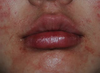 Lip Augmentation Before & After Gallery - Patient 250107 - Image 2