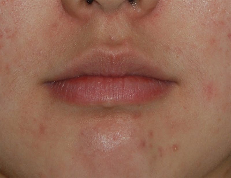 Lip Augmentation Before & After Gallery - Patient 250107 - Image 3