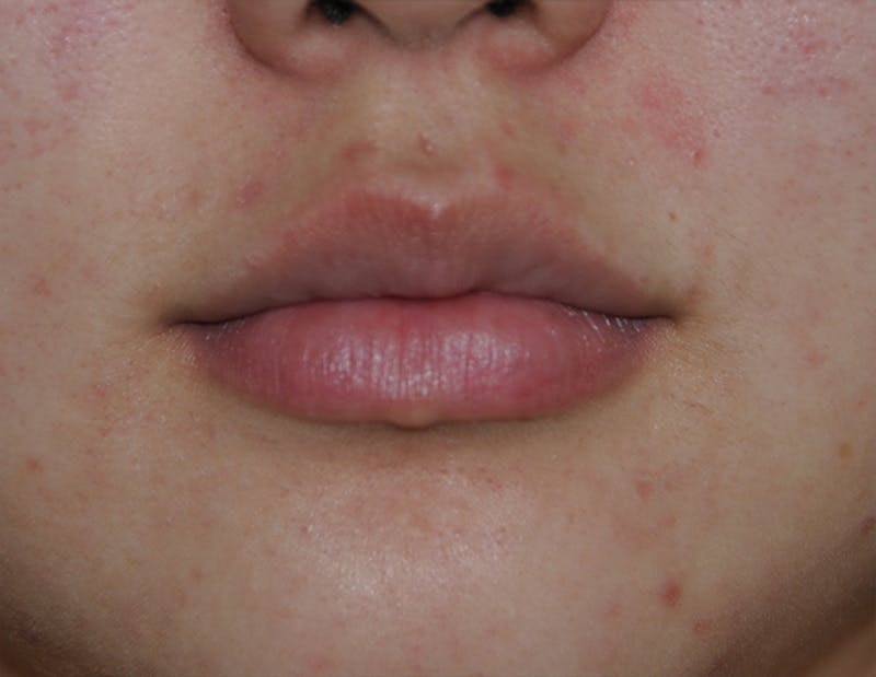Lip Augmentation Before & After Gallery - Patient 250107 - Image 4