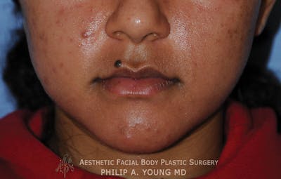 Lip Augmentation Before & After Gallery - Patient 182400 - Image 1