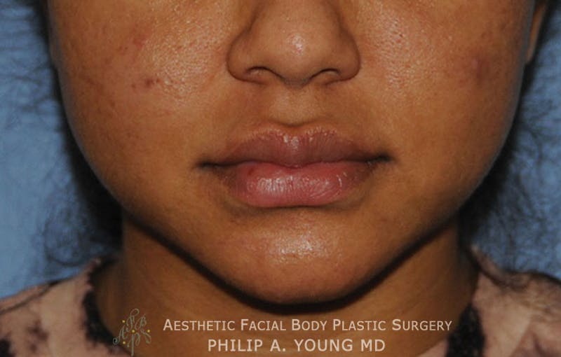 Lip Augmentation Before & After Gallery - Patient 182400 - Image 2