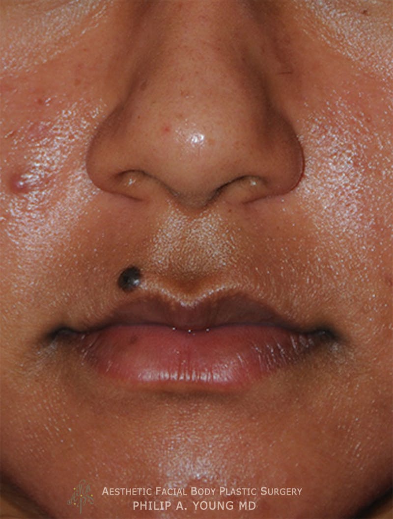 Lip Augmentation Before & After Gallery - Patient 182400 - Image 3