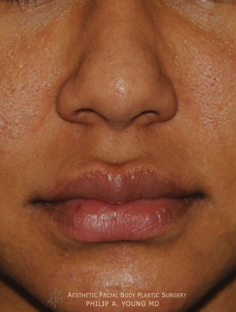 Lip Augmentation Before & After Gallery - Patient 182400 - Image 4