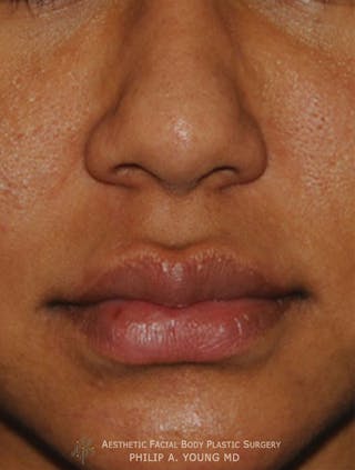 Lip Augmentation Before & After Gallery - Patient 182400 - Image 4