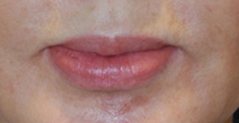 Lip Augmentation Before & After Gallery - Patient 288942 - Image 1