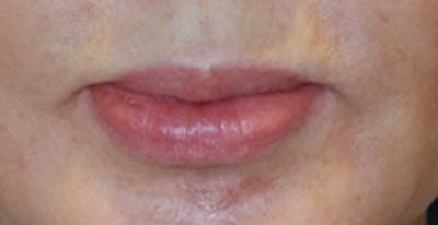 Lip Augmentation Before & After Gallery - Patient 288942 - Image 1
