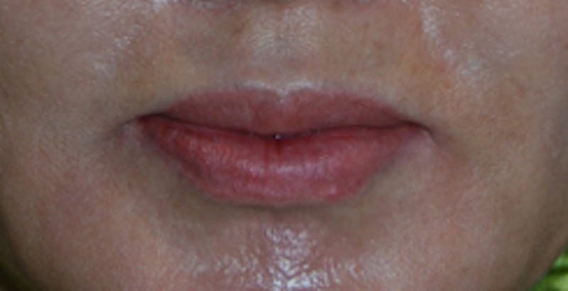 Lip Augmentation Before & After Gallery - Patient 288942 - Image 2